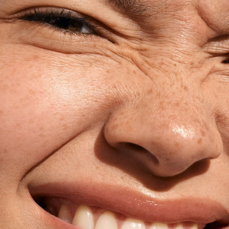 Arrugas y Ojeras